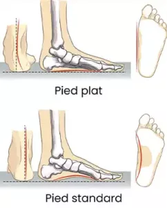 Schéma Pieds plats suivi médical X fragile